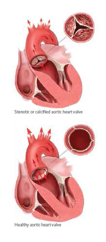 Illustration of stenotic and healthy aortic heart valve