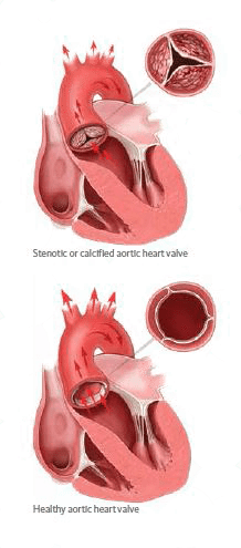 Illustration of stenotic and healthy aortic heart valve