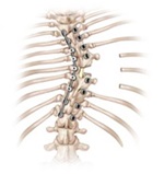 Illustration of a spine with scoliosis.