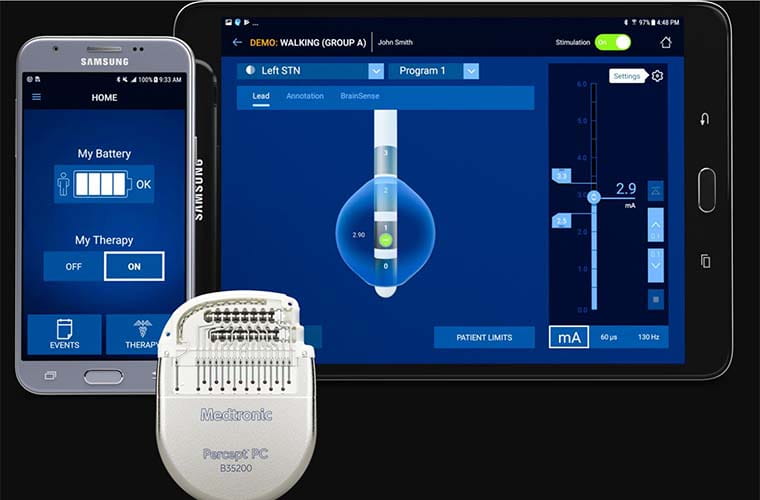 Morton Plant Hospital Offers New Technology  to treat Neurological Disorders