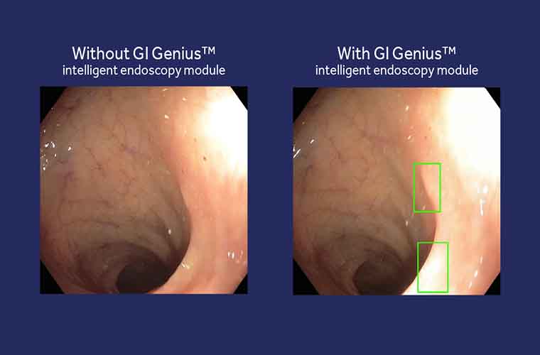 A side-by-side comparison of what the gastroenterologist sees with and without the module.