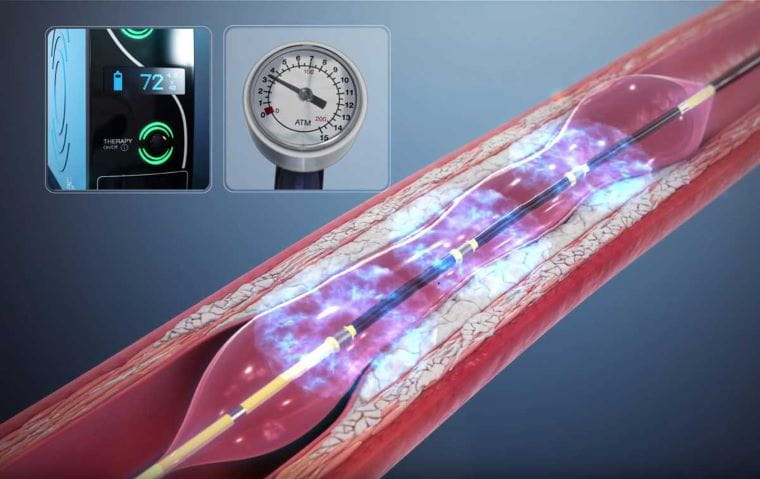 A depiction of a shockwave catheter in an artery.