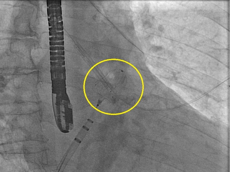 A computer monitor displays a medical imaging scan, showing internal pathways and the Watchman medical device.