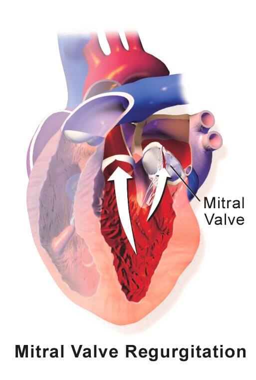 a diagram of mitral valve regurgitation versus stenosis