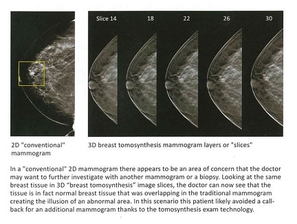 3-D Tomosynthesis Mammography