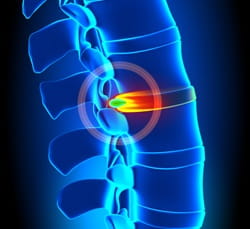 An illustration of a herniated disc