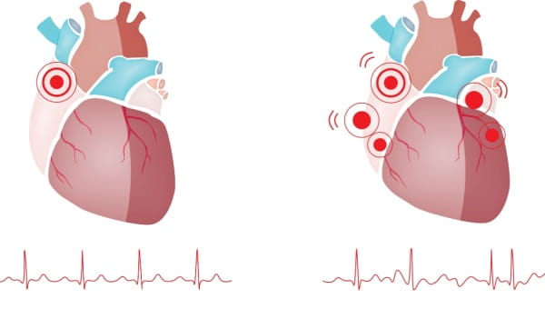 Illustration of a heart: left side depicts normal rhythm, right side illustrates atrial fibrillation.