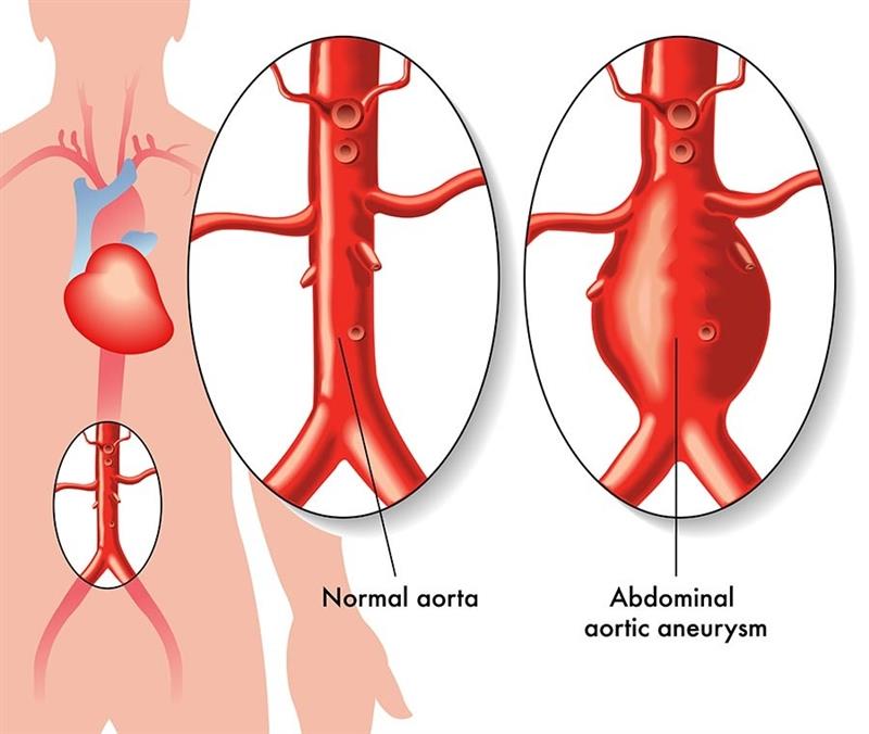 A diagram showing a abdominal aortic aneurysm vs a normal aorta. The normal aorta is thin, and the AAA is enlarged.
