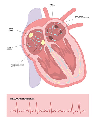 a diagram showing the irregular heartbeat before cardiac ablation 