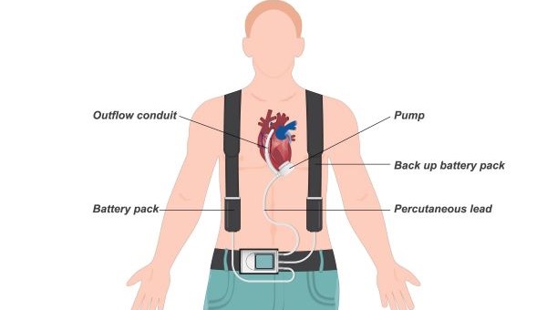A diagram showing the parts of ventricular assist devices, including the outflow conduit, battery pack, pump, the back up battery pack, and the percutaneous lead.