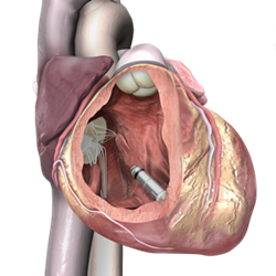 Implantation of a Micra TPS pacemaker