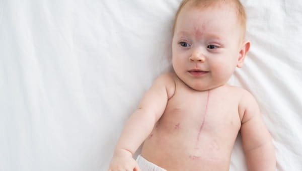 baby laying on a white blanket that has a vertical scar on the chest